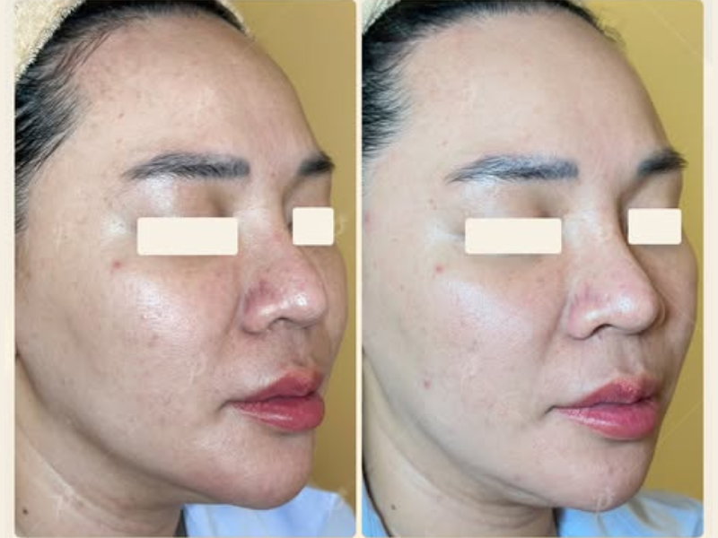 HỒI SINH DA CHỚM LÃO HÓA CHỈ SAU 1 THÁNG