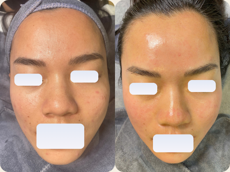 GIẢI CỨU LÀN DA MỤN VIÊM, THÂM SẠM CHỈ SAU 3 TUẦN