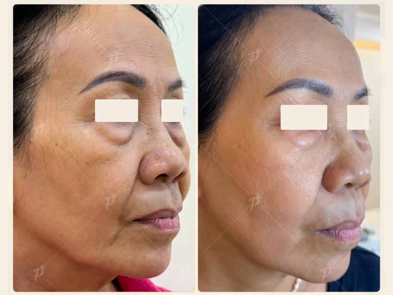 TRẺ HÓA LÀN DA 60+ TUỔI CHỈ TRONG 1 THÁNG