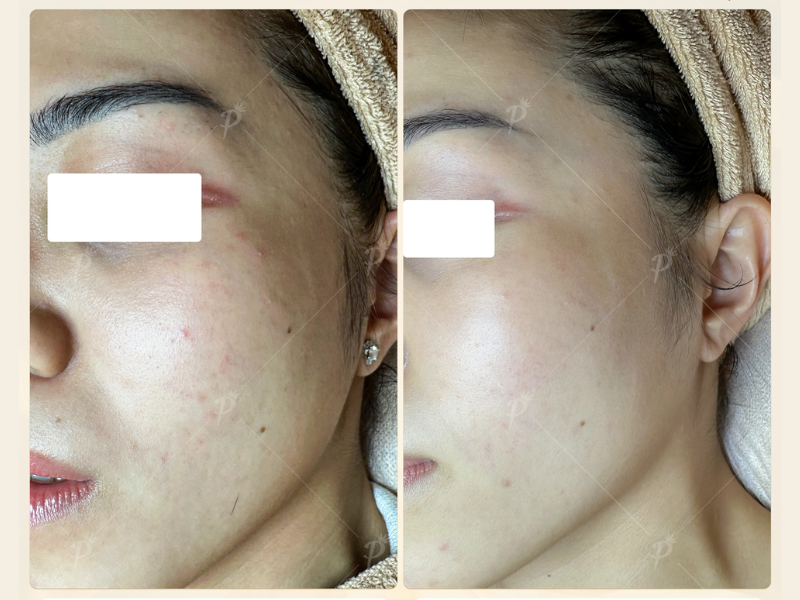 CẤP CỨU LÀN DA ĐÔ THỊ MỤN VIÊM & KÍCH ỨNG CHỈ TRONG 1 THÁNG